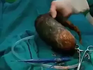 Hobi Ngemil Rambut, Ada 7 Kg Bola Rambut di Perut Remaja Ini