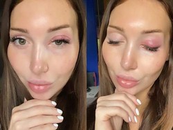 Extension Bulu Mata Gagal, Mata Model Ini Bengkak Hingga Harus Berobat ke RS