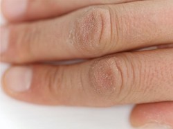 Kulit Kering Setelah Pakai Hand Sanitizer? Ini Cara Atasinya