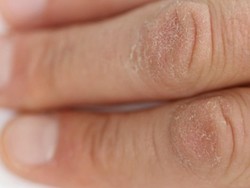 Kulit Kering Setelah Pakai Hand Sanitizer? Ini Cara Atasinya