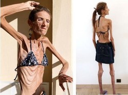 Valeria Levitin Meninggal karena Anoreksia, Ini Penyakit dan Gejalanya