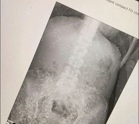 Stupid appearance of hundreds of implants in the body of a 55-year-old woman