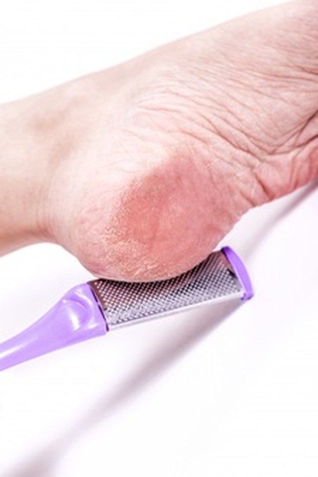 Tumit Pecah-Pecah/ Sumber: Freepik.com Perawatan pertama untuk tumit pecah-pecah adalah menggunakan balm untuk tumit. Biasanya produk balm untuk tumit mengandung bahan untuk melembabkan, melembutkan, dan mengelupas kulit mati.