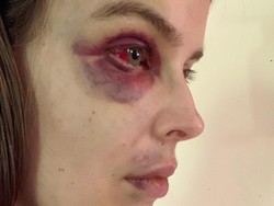 Model Cantik Ini Unggah Wajah Babak Belur, Alami Kondisi Kesehatan Kronis