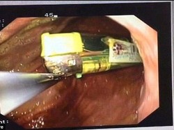 Karena Mabuk Berat, 5 Orang Ini Telan Sendok hingga Korek Api