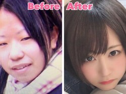 Posting Foto Before After Oplas, Wanita Ini Bikin Netizen Tidak Percaya