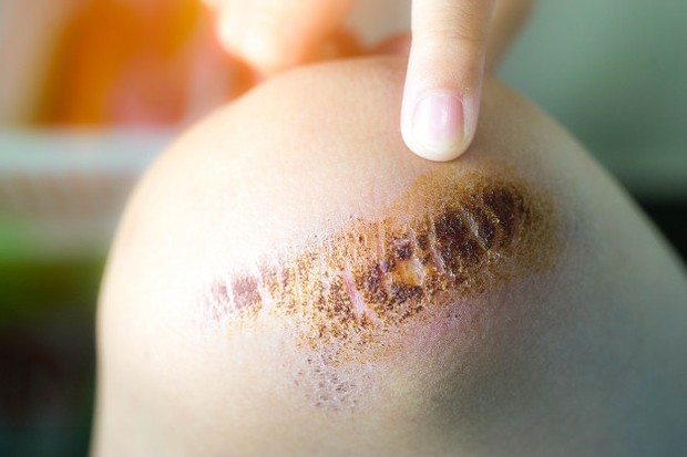 Penanganan Luka Bakar/ Sumber: Freepik.com Perlu diketahui bahwa luka bakar yang menyebabkan kulit hangus, kasar atau kehilangan indera perasa adalah luka bakar yang sangat parah dan harus segera mendapat perhatian medis.