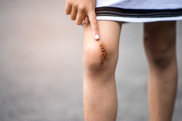 Pengobatan Luka Bakar pada Anak/ Sumber: Freepik.com Dinginkan luka bakar dengan mengalirkan air dingin yang mengalir di atas luka bakar selama sekitar lima menit.