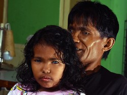 Kisah Zizy, Bocah Perempuan Bermata Biru di Pekanbaru