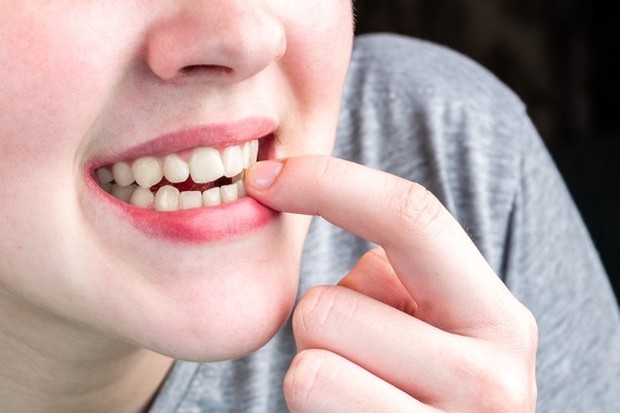 Autokanibalisme/ Sumber: Freepik.com Kebanyakan orang dengan autokanibalisme memiliki kondisi kesehatan mental lain yang mendasari, seperti OCD atau kecemasan.