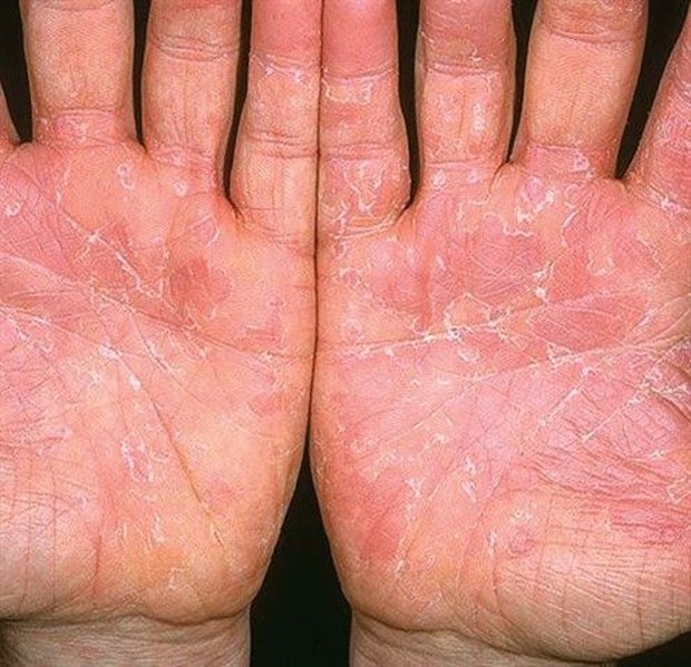 tangan yang kering dan kasar/Foto: pinterest tangan kering dan kasar karena terlalu sering mencuci tangan