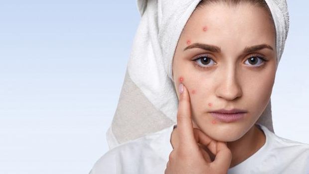 Stres dan cemas akan memicu inflamasi kulit dan munculnya dark spot atau bintik hitam pada kulit.