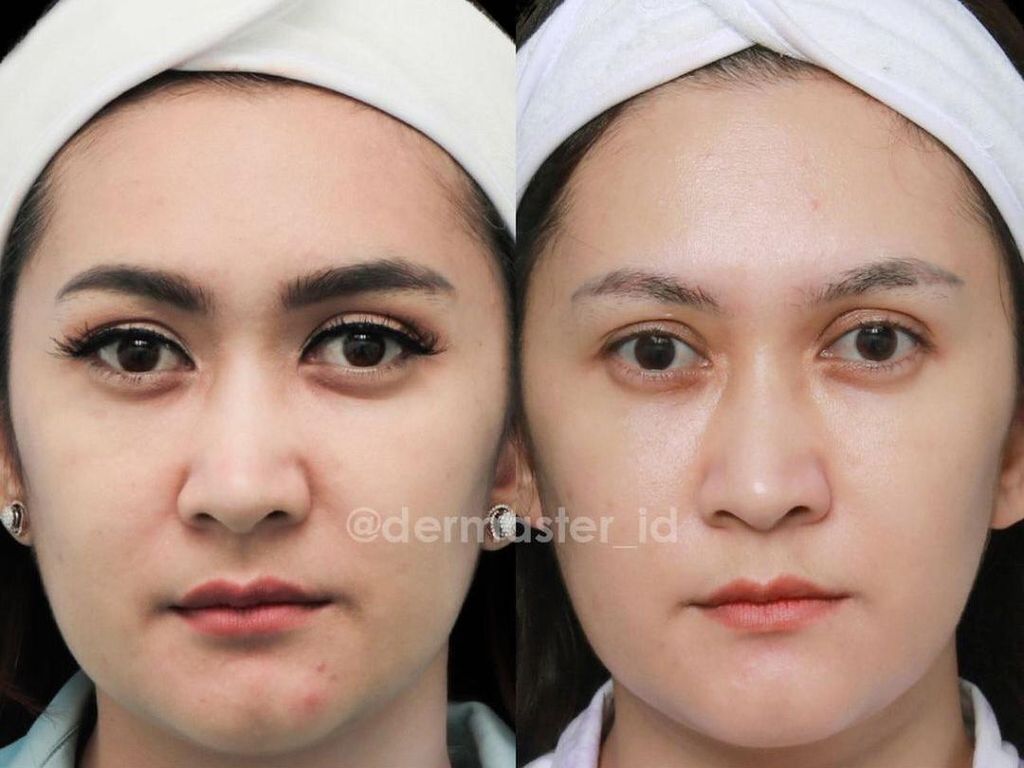 Most Pop Sepekan: Foto Before-Artis Tanam & Tarik Benang, Siapa Tercantik? Most Pop Sepekan: Foto Before-Artis Tanam & Tarik Benang, Siapa Tercantik?