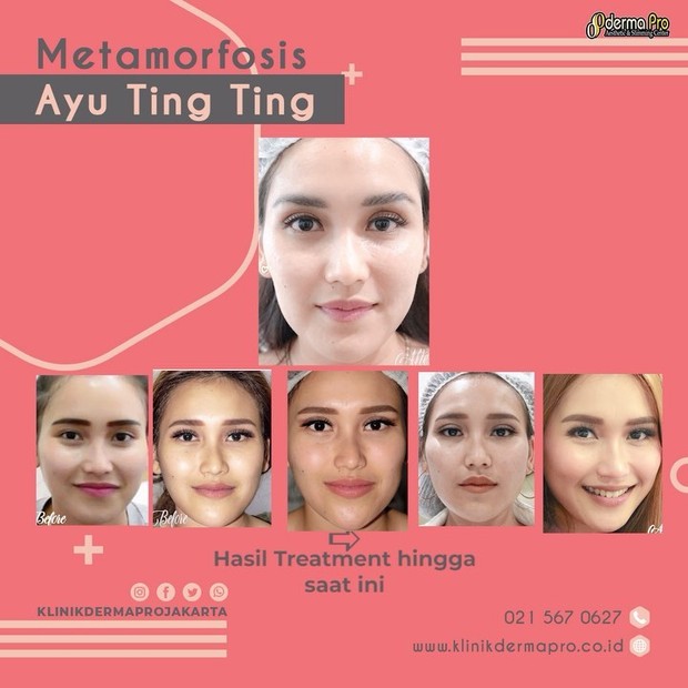 https://www.instagram.com/ayutingting92/ Foto-foto perubahan atau metamorfosis wajah Ayu Ting Ting selama menjalani perawatan kecantikan dibagikan klinik Derma Pro Jakarta.