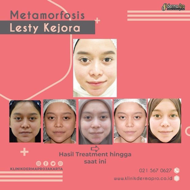 https://www.instagram.com/klinikdermaprojakarta/ Akun Instagram Klinik Derma Pro Jakarta, klinik kecantikan tempat Lesti Kejora melakukan perawatan, membagi foto metamorfosis wajah Lesti sebelum dan sesudah menjalani perawatan.