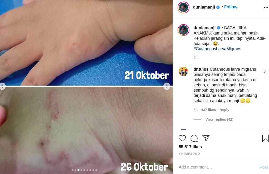 Anak Anji Kena Cutaneous Larva Migrans
