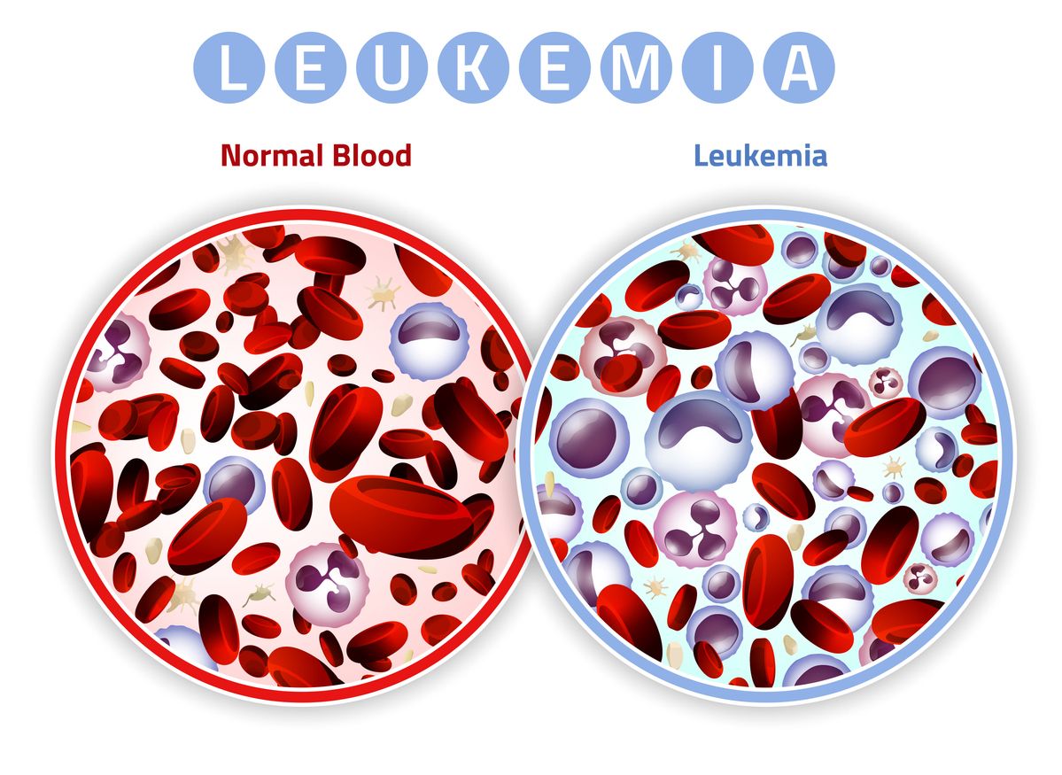 Penyebab leukemia