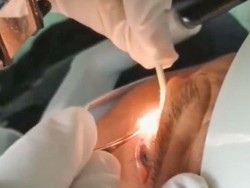 Ngeri Banget, Dokter Ini Temukan 20 Cacing Hidup di Mata Seorang Kakek