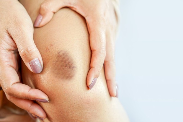 Jika kamu memiliki bekas memar ringan, kamu bisa coba untuk menggunakan Vicks VapoRub.