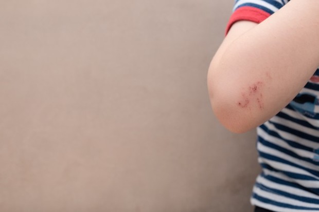 Petroleum di Vicks VapoRub dapat membantu menyembuhkan luka dan goresan kecil bila dioleskan sekali atau dua kali sehari.