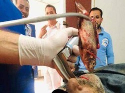 Ngeri! Ikan Hidup Terjebak di Dalam Tenggorokan Nelayan