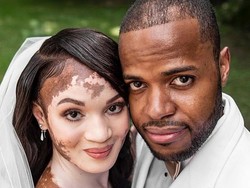 Wanita dengan Vitiligo Sulit Dapat Pacar, Berakhir Dilamar Pria Sejati