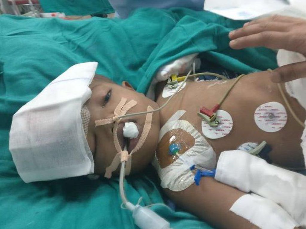Kembar Siam Dempet Kepala Meninggal 3 Tahun Usai Operasi Pemisahan Kembar Siam Dempet Kepala Meninggal 3 Tahun Usai Operasi Pemisahan