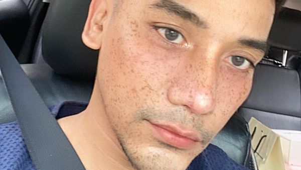 Foto: Penampilan Baru MUA Bubah Alfian Setelah Operasi Plastik Hidung