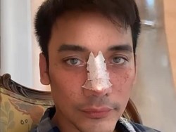 Perjalanan MUA Bubah Alfian Operasi Hidung, Tulang Hidung Sempat Keropos