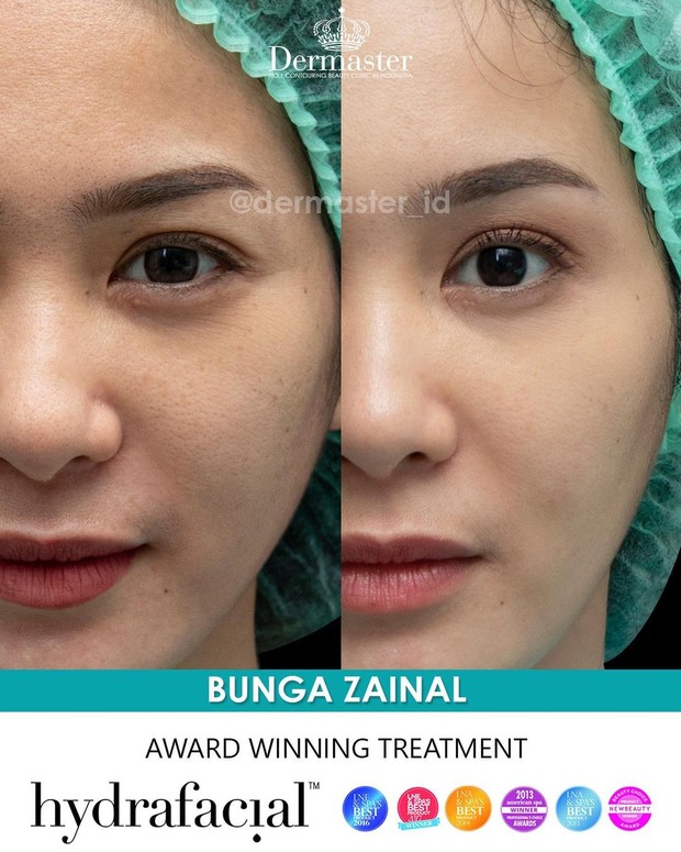 Bunga Zainal Dermaster Clinic/instagram.com/dermaster_id/