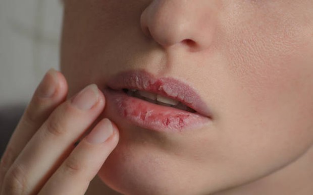 Bibir kering dan pecah-pecah / Foto: istockphoto.com