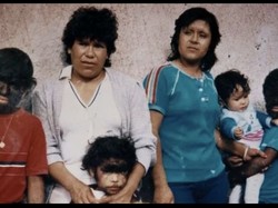 20 Anak Tumbuh Rambut di Seluruh Tubuh Gegara Salah Minum Obat