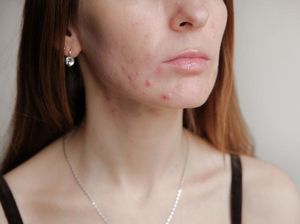 6 Makanan Ini Bisa Mengatasi Jerawat yang Meradang 6 Makanan Ini Bisa Mengatasi Jerawat yang Meradang