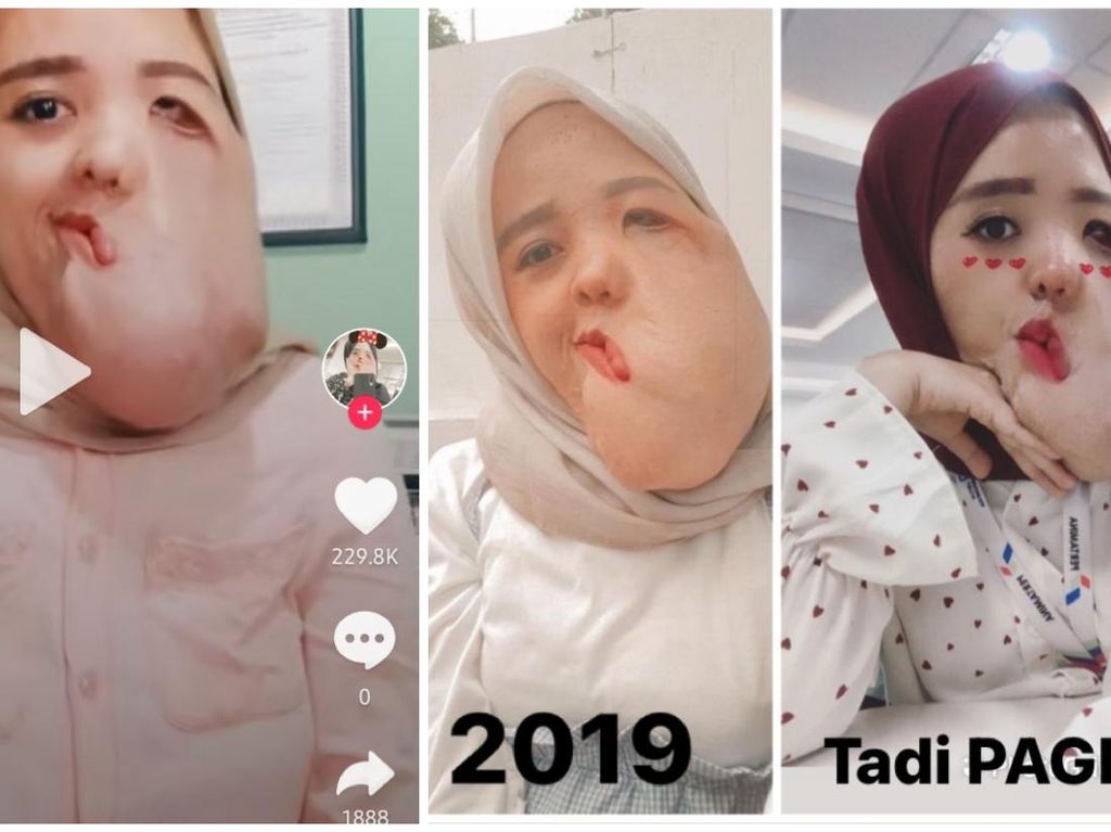 Viral Idap Tumor hingga Wajah Bengkak, Pesan Anti Insecure-nya Bikin Terenyuh Viral Idap Tumor hingga Wajah Bengkak, Pesan Anti Insecure-nya Bikin Terenyuh