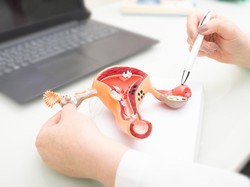 Kisah Nyata 2 Wanita yang Sembuh dari Kanker Serviks, Termasuk dari Indonesia