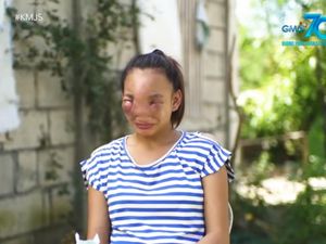 Kisah Remaja Menderita karena Pencet Jerawat, Wajah Bengkak & Susah Melihat