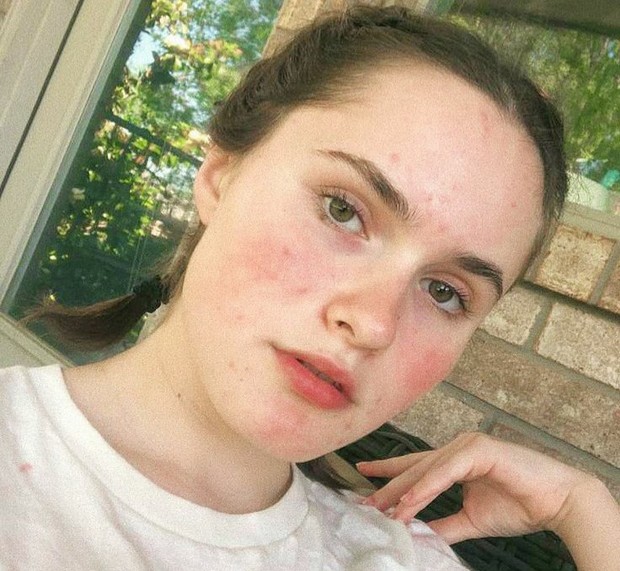 Over-exfoliating bisa mengiritasi kulitmu/Foto: Pinterest/anitaotheinternet kebiasaan buruk terhadap kulit wajah