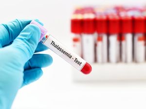 Dokter Dorong Skrining Thalasemia Sebelum Nikah Biar Tak Turunkan Penyakit ke Anak Dokter Dorong Skrining Thalasemia Sebelum Nikah Biar Tak Turunkan Penyakit ke Anak