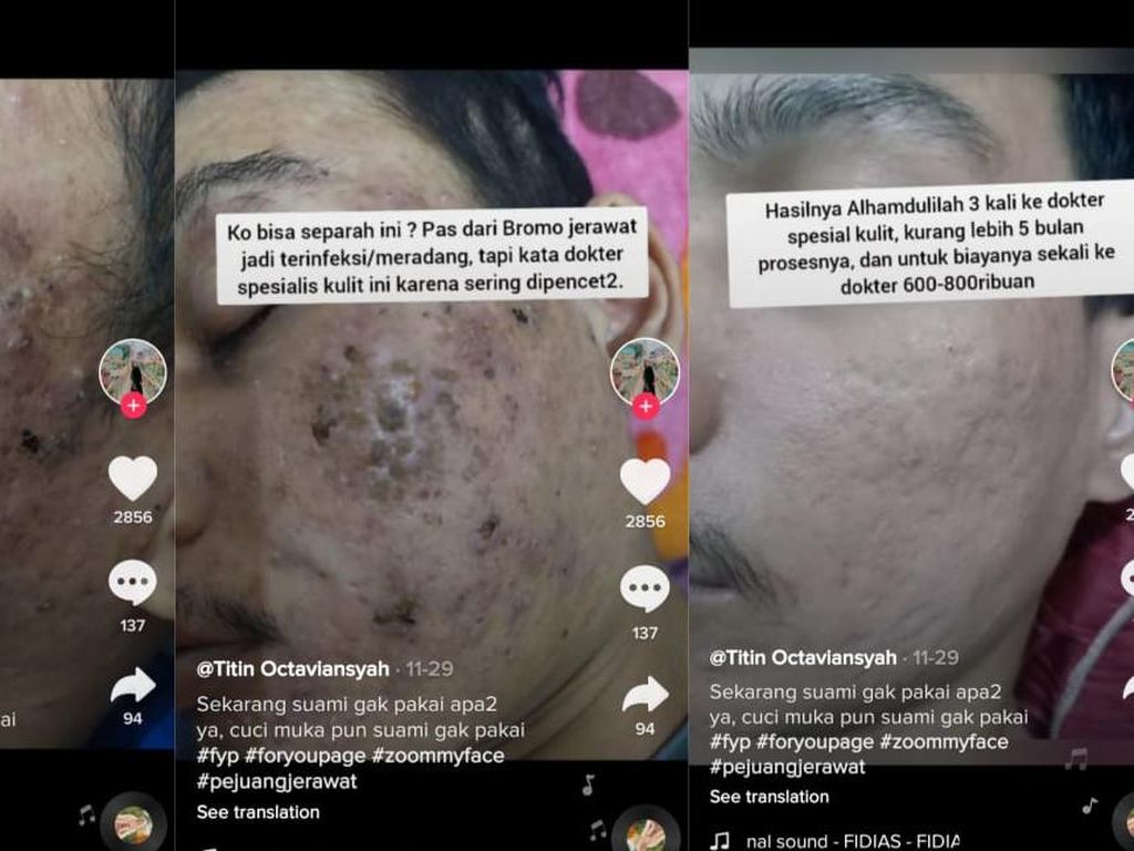 Hobi Pencetin Jerawat? Hati-hati, Dampaknya Bisa Seperti Ini Hobi Pencetin Jerawat? Hati-hati, Dampaknya Bisa Seperti Ini