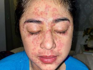 3 Fakta Ruam Kulit, Gejala COVID-19 yang Dialami Dewi Perssik 3 Fakta Ruam Kulit, Gejala COVID-19 yang Dialami Dewi Perssik