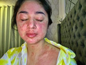 Ruam Gejala COVID-19 Vs Ruam Biasa, Bedanya Apa Sih? Ini Kata Dokter Kulit Ruam Gejala COVID-19 Vs Ruam Biasa, Bedanya Apa Sih? Ini Kata Dokter Kulit