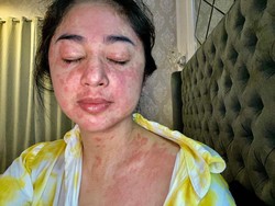 Dialami Dewi Persik Saat Kena Corona, Ini Tanda Ruam yang Jadi Gejala COVID-19
