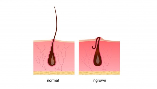 ingrown hair