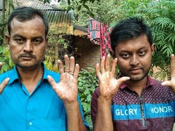 Kisah Keluarga Langka Tanpa Sidik Jari, Sulit Pergi ke Luar Negeri