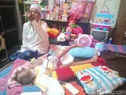 Kasihan, Tangan Bocah 5 Tahun di Madiun Ini Membesar Karena Kanker Tulang