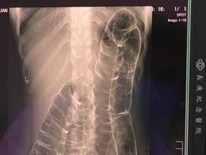 Wanita Sering Alami Sembelit Bagikan Foto Rontgen Ususnya yang Bikin Syok