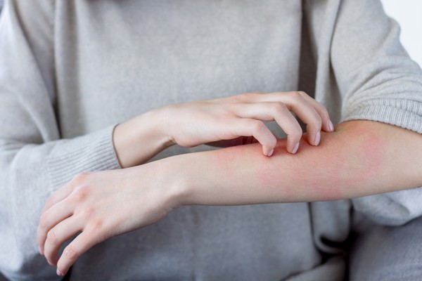 Ilustrasi ruam kulit Closeup girl is scratching her hand with nails. Reddened, inflamed body parts causes discomfort and itching. Young woman is suffering from bouts of allergies. Dermatological skin diseases concept.