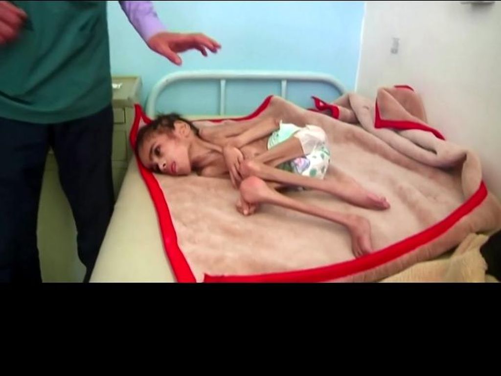 Dilanda Kelaparan, Bocah 7 Tahun di Yaman Hanya Miliki Berat 7 Kg