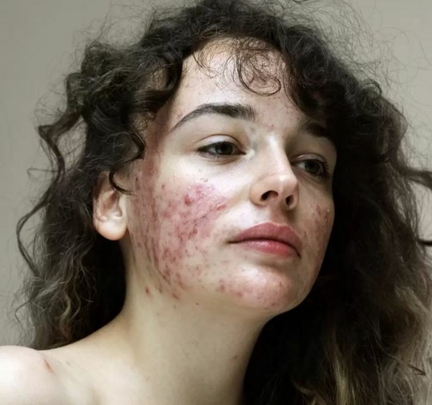 Foto bertema Epidermis karya Sophie/Foto: Pinterest/glamourmaguk skin positivity