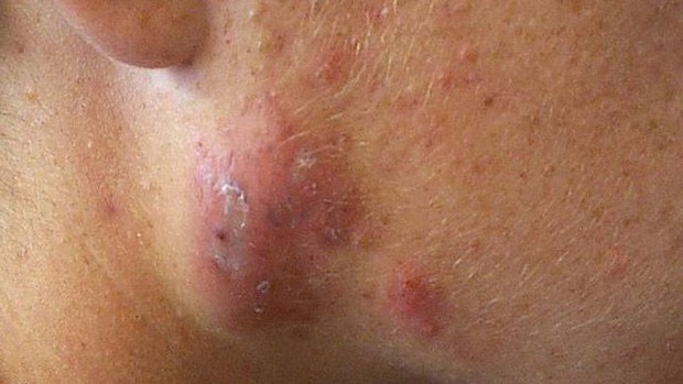 Cystic acne.